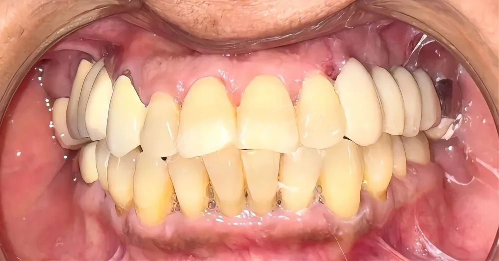 Close frontal intraoral photograph showing upper fixed restorations and lower anterior teeth